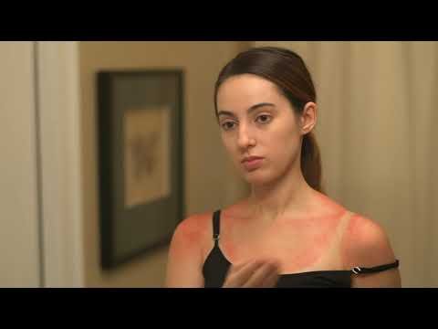 Common Summer Rashes: Prevention & Treatment – Health Video Tips