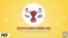 PCOS- (Poly-Cystic Ovarian Syndrome)