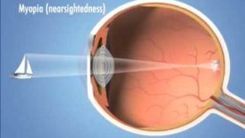 Refractive Errors of Eye