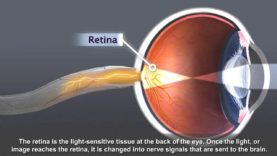 Understanding Cataract