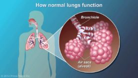 Understanding COPD (Chronic Obstructive Pulmonary Disease)