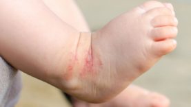 Eczema: Helpful Tips