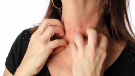 Eczema: Myths & Misconceptions